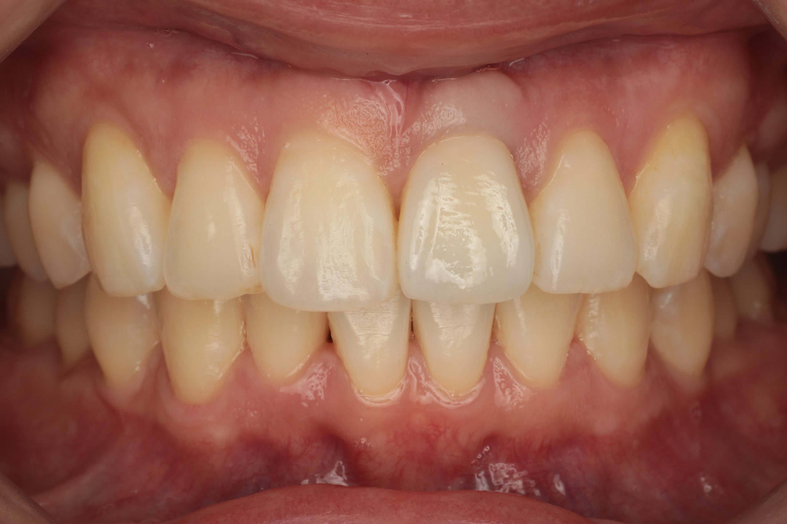 Dental treatment after image - Case 1