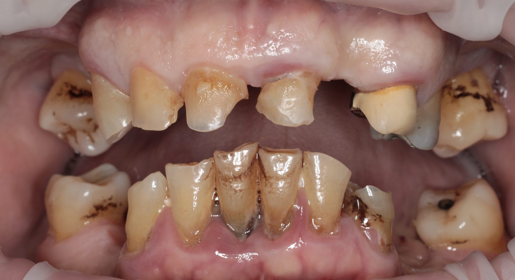 Full mouth rehabilitation before image