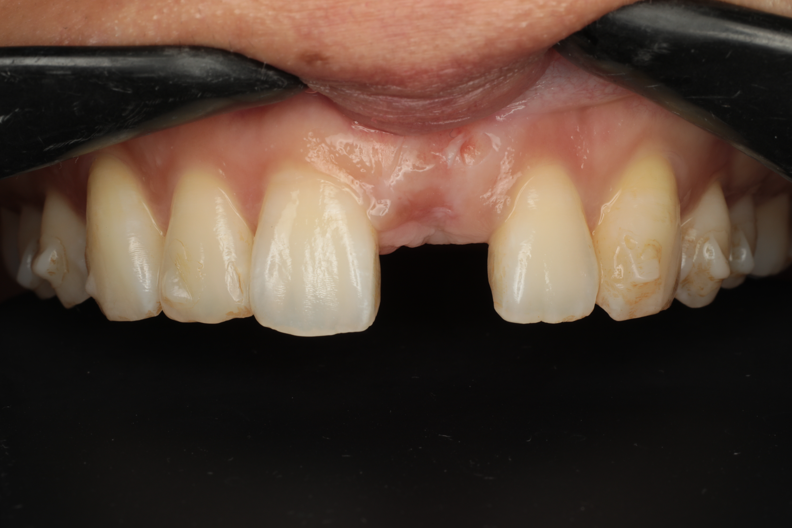 Dental treatment before image - Case 1