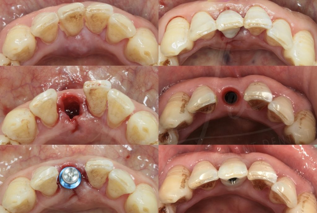 Dental smile gallery - Case 3